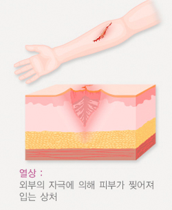 열상 뜻 열상뜻