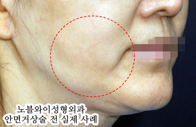  안면거상술잘하는성형외과 오래된 후기 많음?