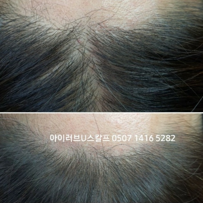  전주 탈모인의 시각으로 두피문신 리뷰 로그.