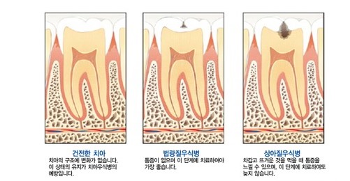 치아 우식증1