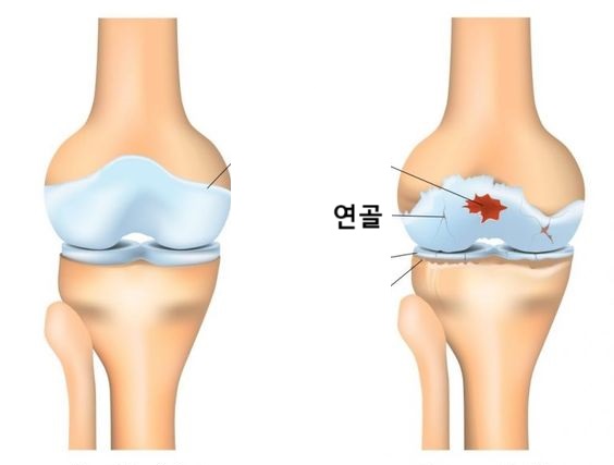 무릎 연골