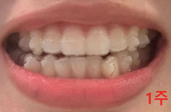 인비절라인-착용-첫날-사진