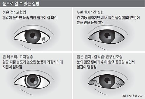  눈에 '이런 변화' 생기면… 고지혈증 신호