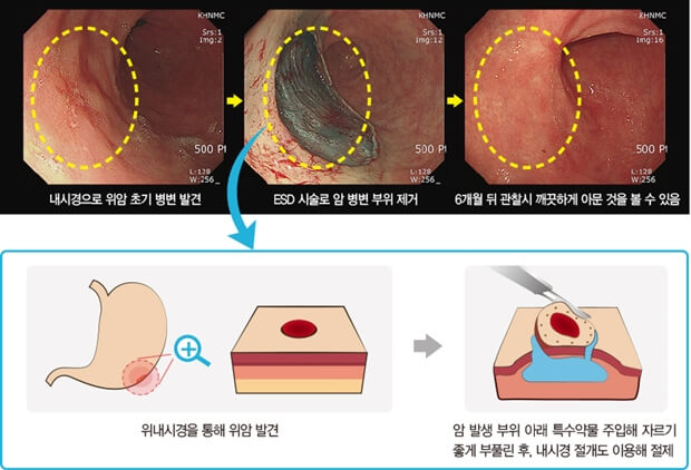 위암 초기증상