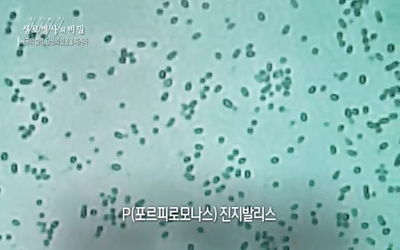 [792회] 생로병사의 비밀 - KBS[세균의 습격, 당신의 잇몸을 지켜라!] 감기보다 병원을 더 자주 찾게 만드는 질병이 있다. 바로 치주질환이다. 2020년 외래 다빈도 질병 1위를 차지한 치은염 및 치주질환 환자는 1,637_20220505_140236.887.jpg
