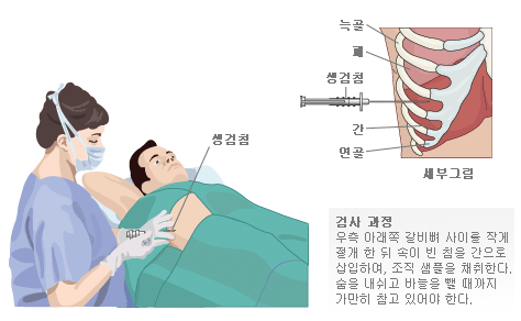 췌장암병원일지(간암, 혈액암, 췌장암 조직검사까지)