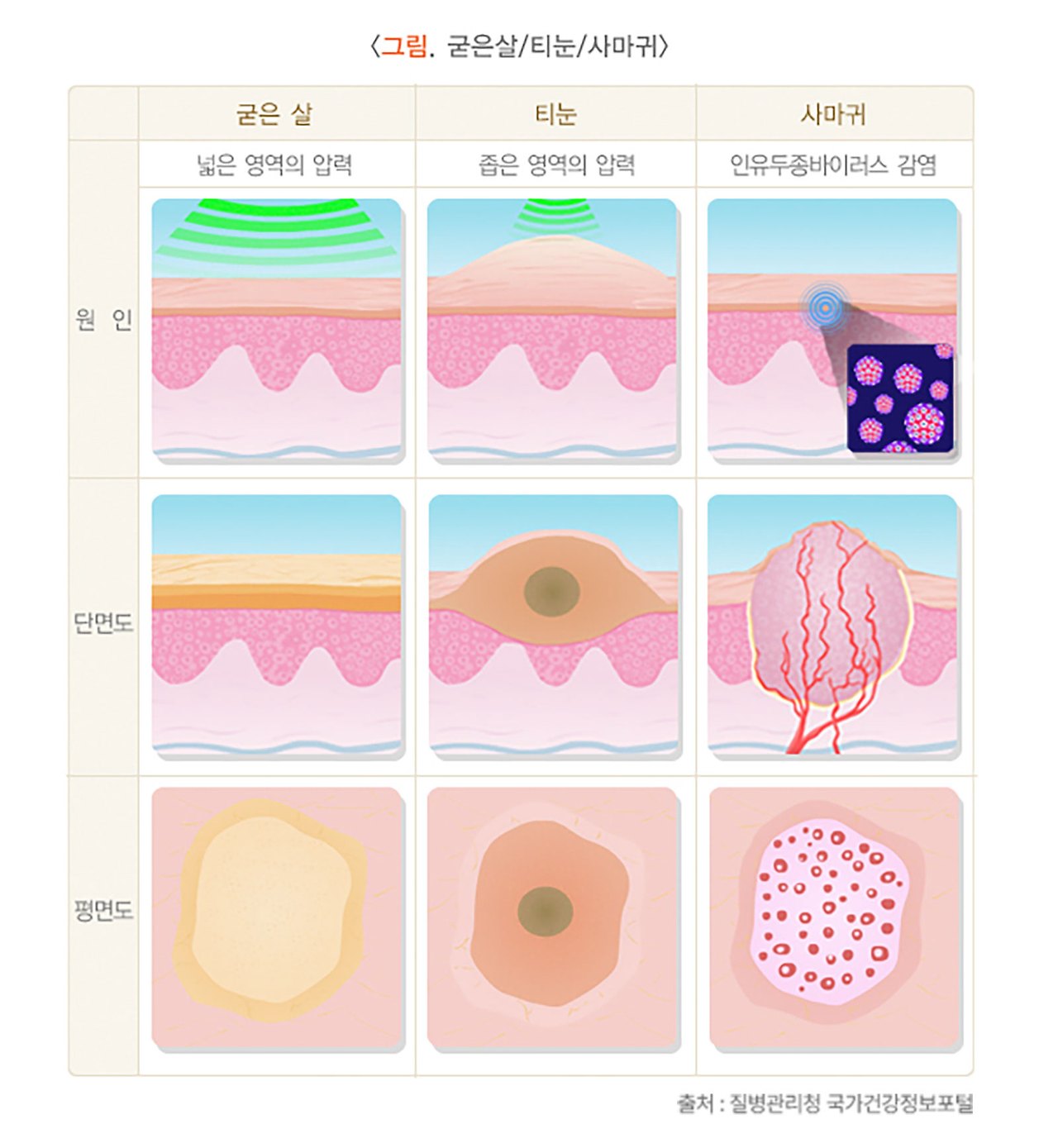 발바닥-티눈-제거-없애는법