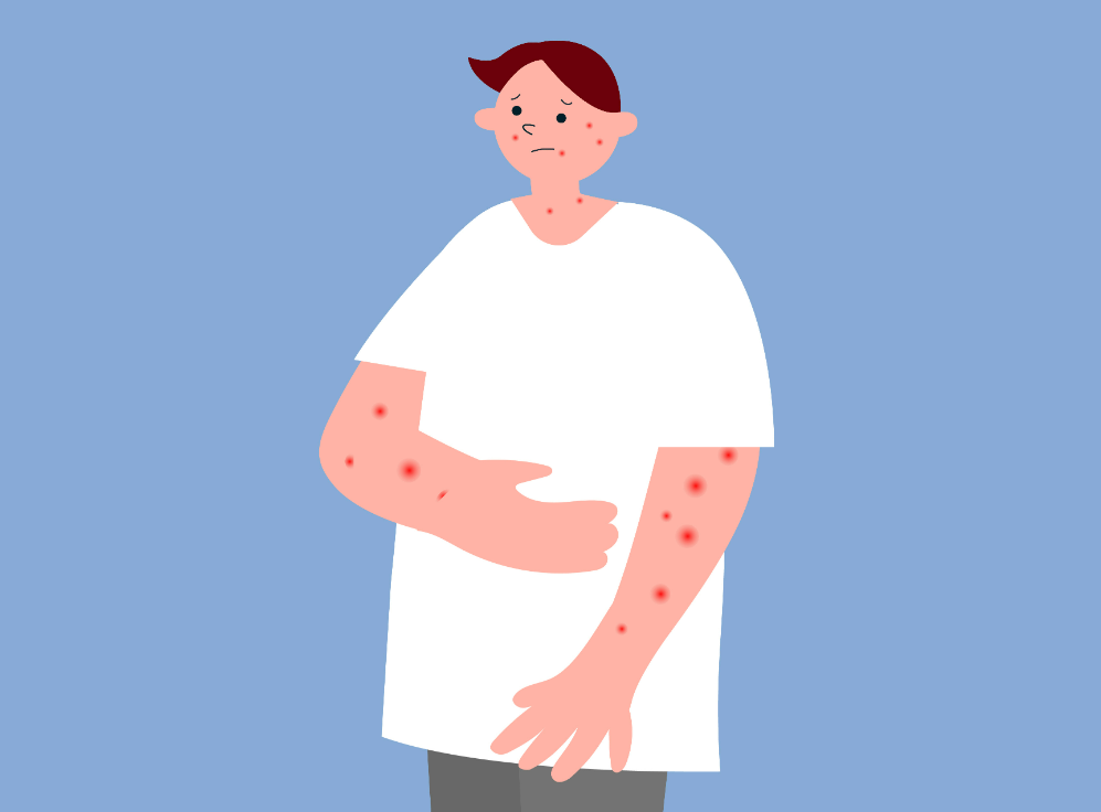  "대상포진(Herpes zoster)의 이해 : 원인, 증상 및 치료 방법"
