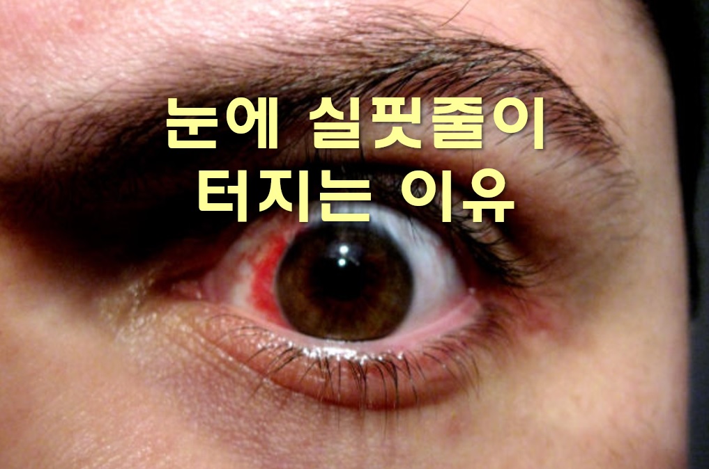 눈에 실핏줄이 터지는 이유와 터졌을 때 하면 좋은 방법