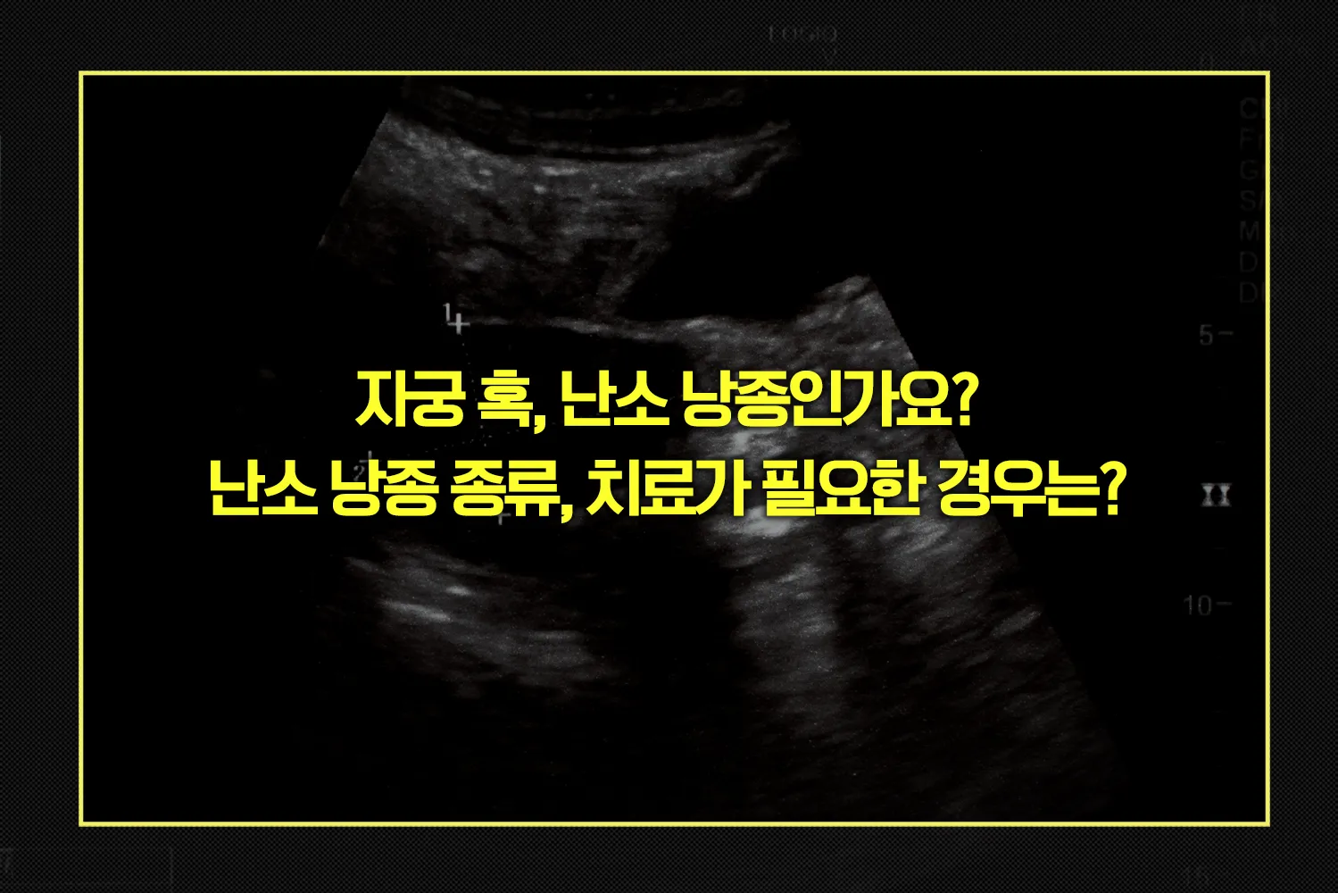 자궁 혹, 난소 낭종 종류