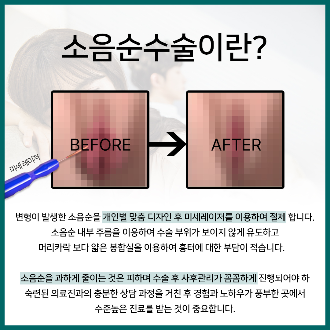 청담 산부인과 소음순성형수술로 소음순미백 효과도 있나요?