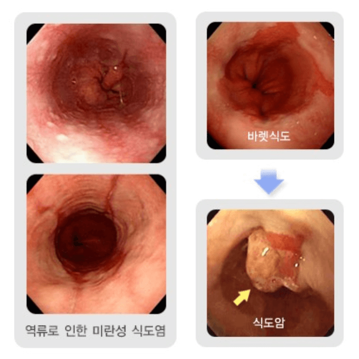 역류성-식도염-관련-질환