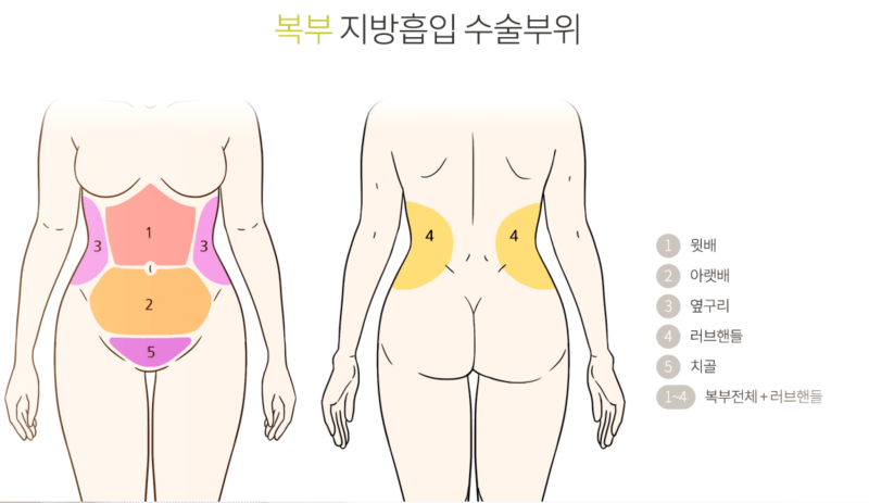 복부-지방흡입-수술부위-그림