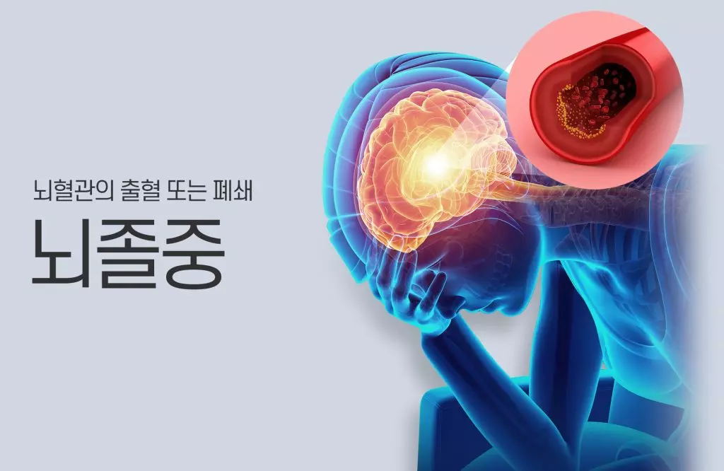 뇌졸중 (Stroke)