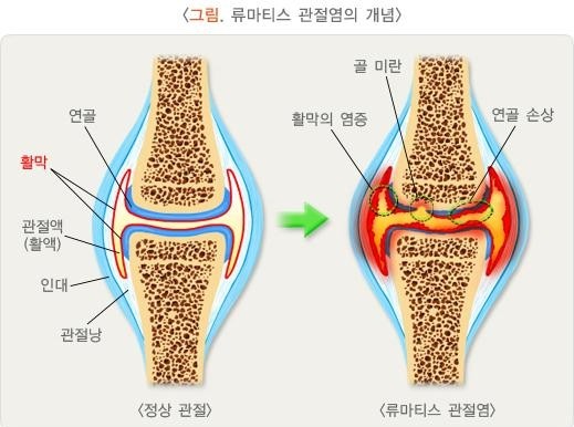 류마티스 관절염