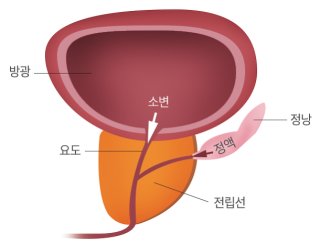 전립선염 증상