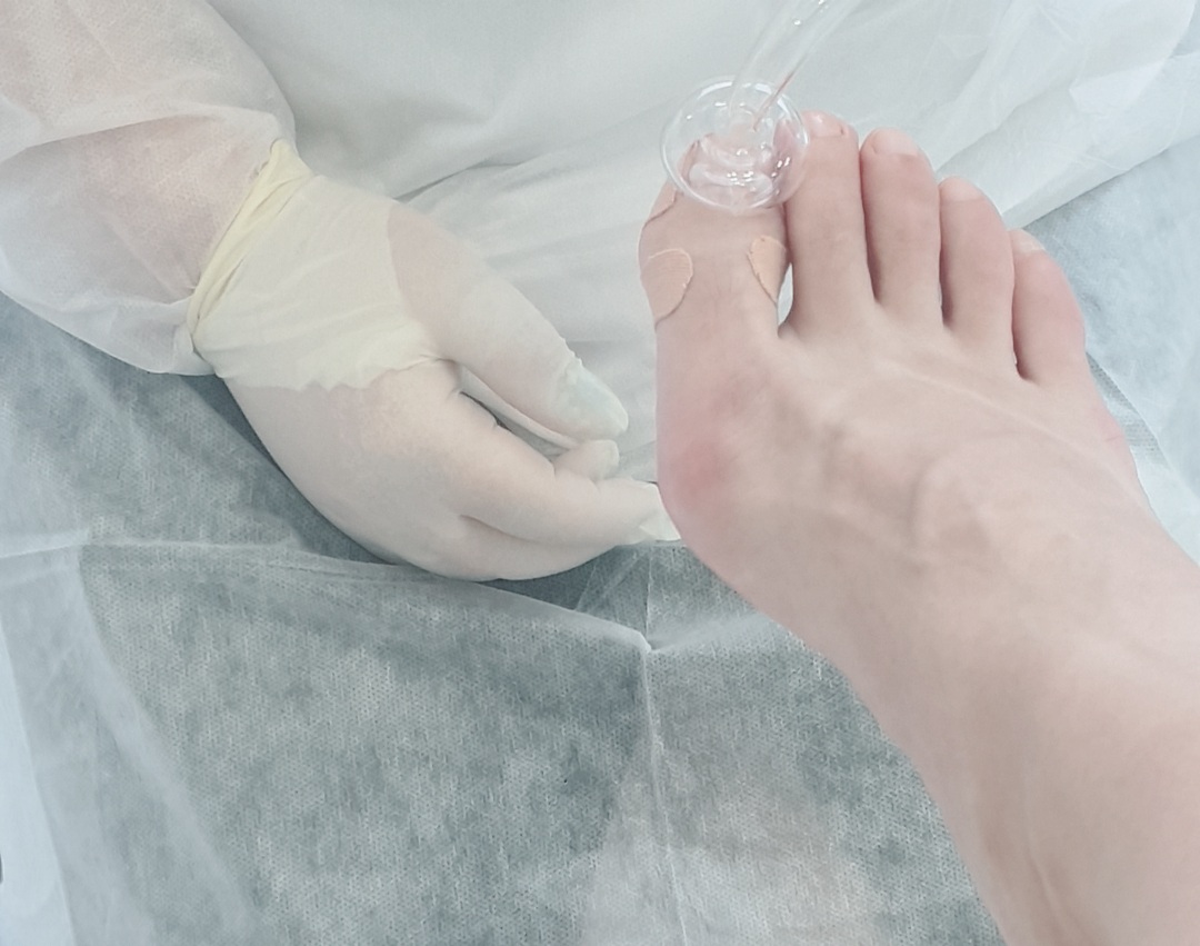  레푸스 가격 + 내성발톱 + 무좀관리+ 항균관리