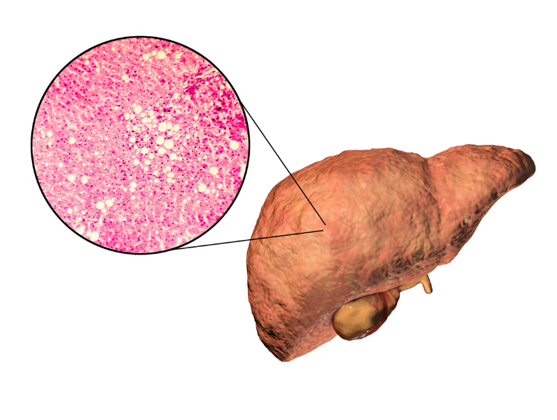 지방간 원인 증상