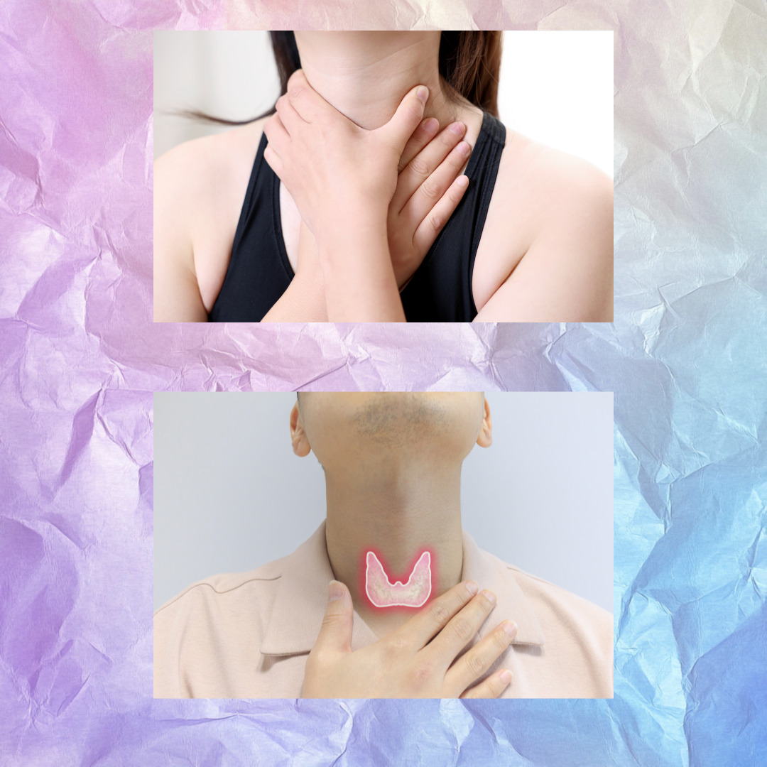 갑상선기능항진증 사진