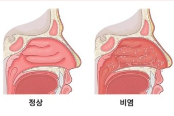 비염이 걸리지 않은 코와 비염이 걸린 코 상태