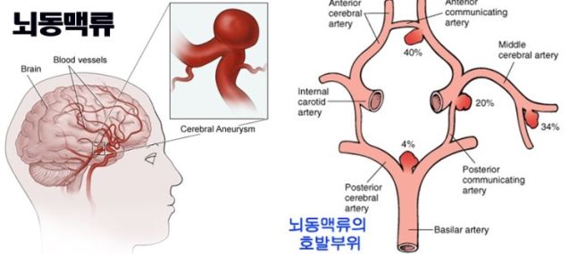 뇌동맥류 증상