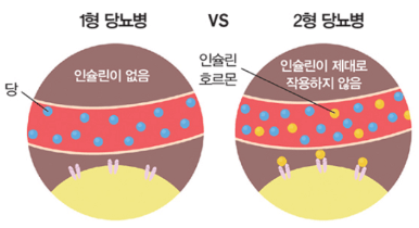 당뇨의-종류