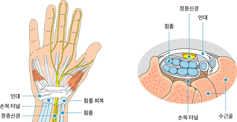 손목터널증후군 증상