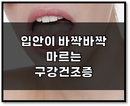  입안이 바짝바짝 마른다는 구강건조증