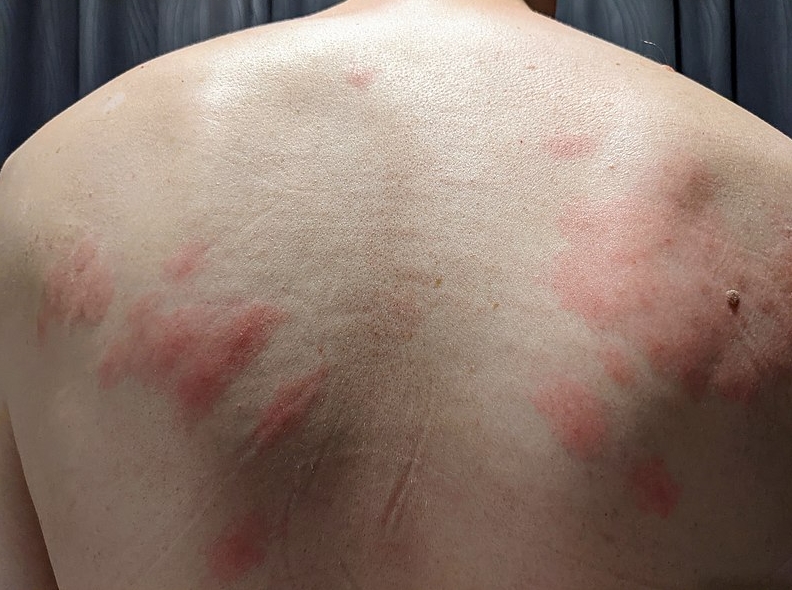  접촉성피부염 원인부터 전염, 증상, 가려움, 치료, 좋은 음식까지 한번에 확인하기