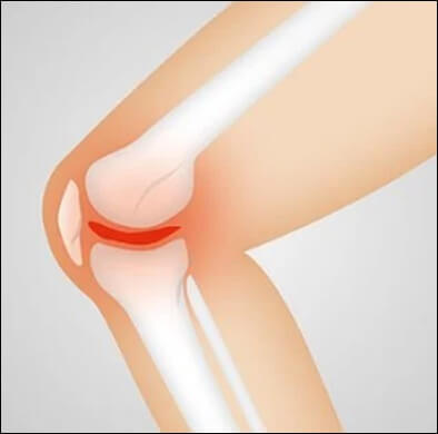 무릎 연골 및 관절 사진