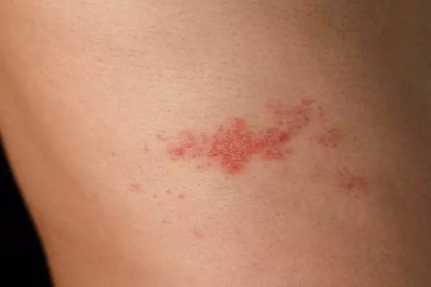 대상포진 초기증상 치료방법