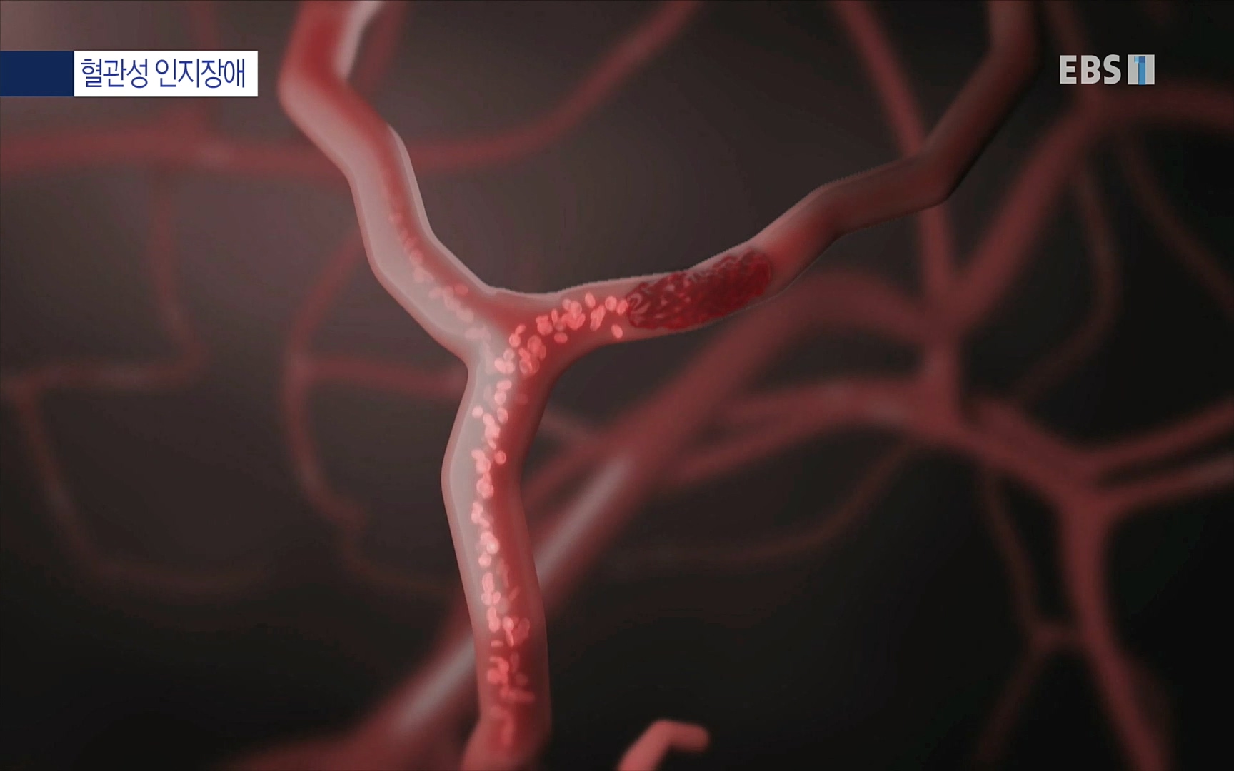 EBS 명의 헬스케어 - TV - 교육의 중심 EBS명의 15년 치매 치료의 패러다임이 바뀐다.mp4_20220808_211008.258.jpg