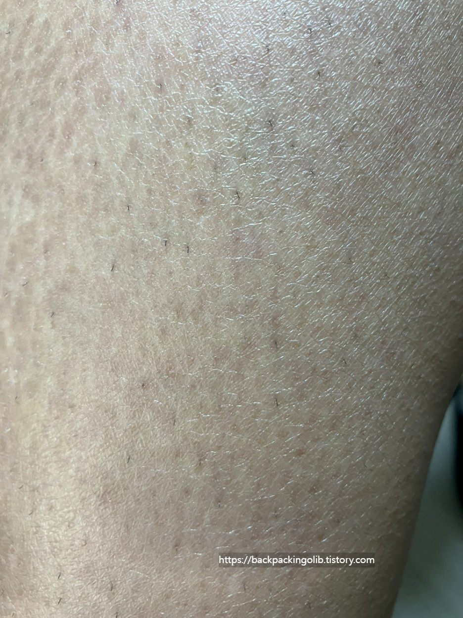 유라이크 사파이어 쿨링 제모기 조사모습