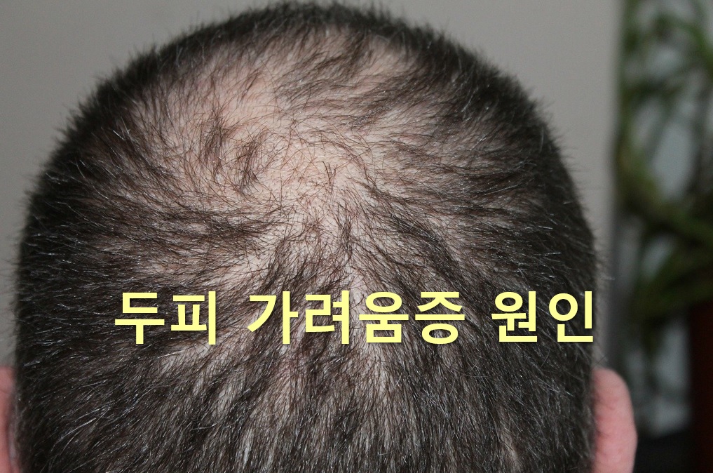 머리가 가려운 이유와 두피 가려움증 원인