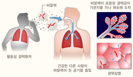  폐결핵 이란?  원인 증상 진단 및 치료 예방 방법 알아보기