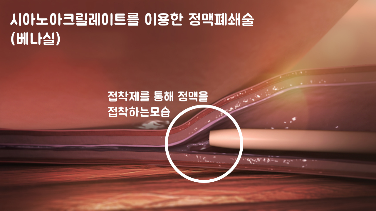 정맥류 수술 비용은?50대 여성의 힐링 스토리 15