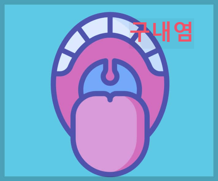  구내염 : 구강안에 상처가 나 하얗게 괴사하는 염증