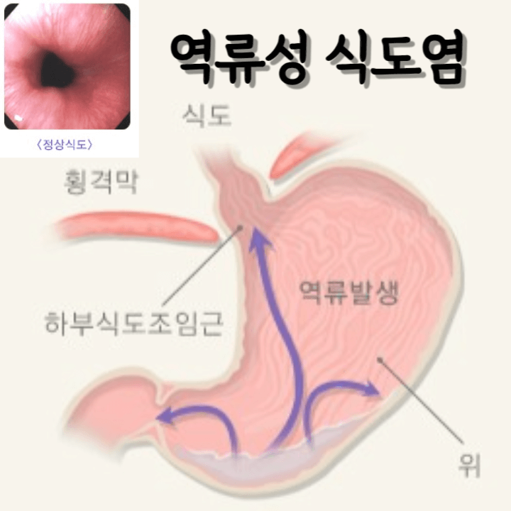 역류성식도염