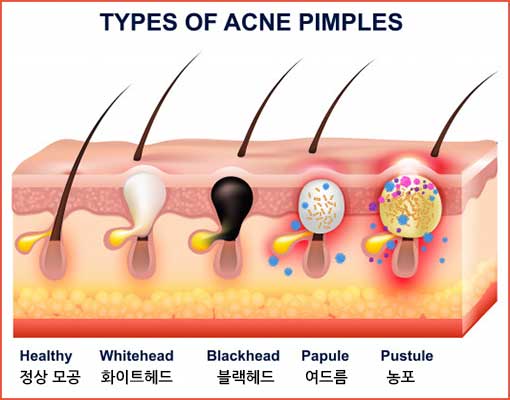 여드름-단계