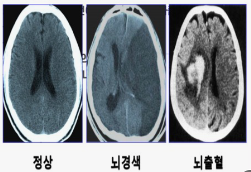 왼쪽부터 정상뇌, 뇌경색 뇌, 뇌출혈 뇌의 MRI 사진이 있다