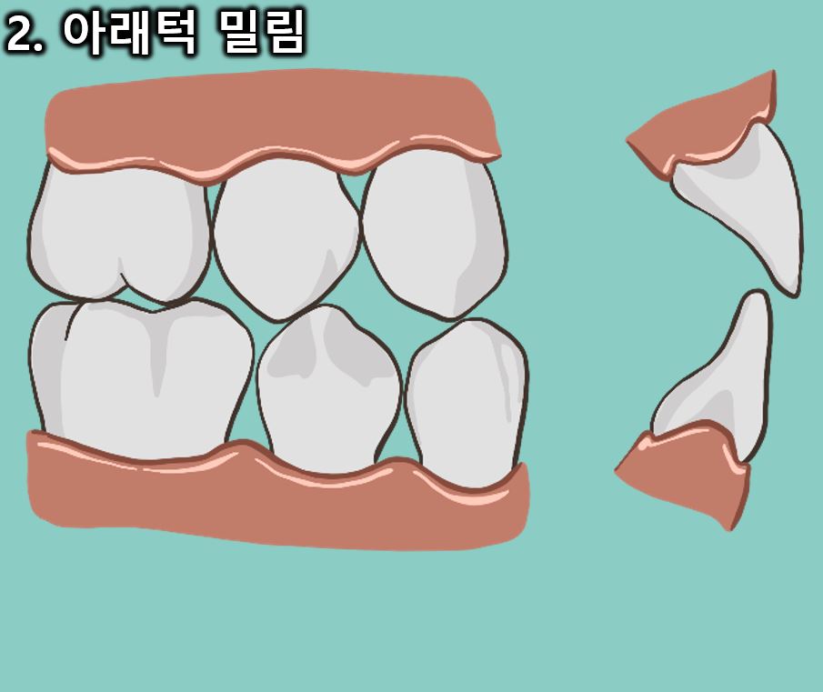 이갈이방지 마우스피스, 스플린트 부작용, 구강내과의사가 알려드림.