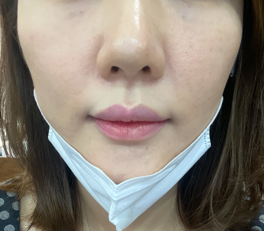 코조각주사 콧볼축소 효과 8