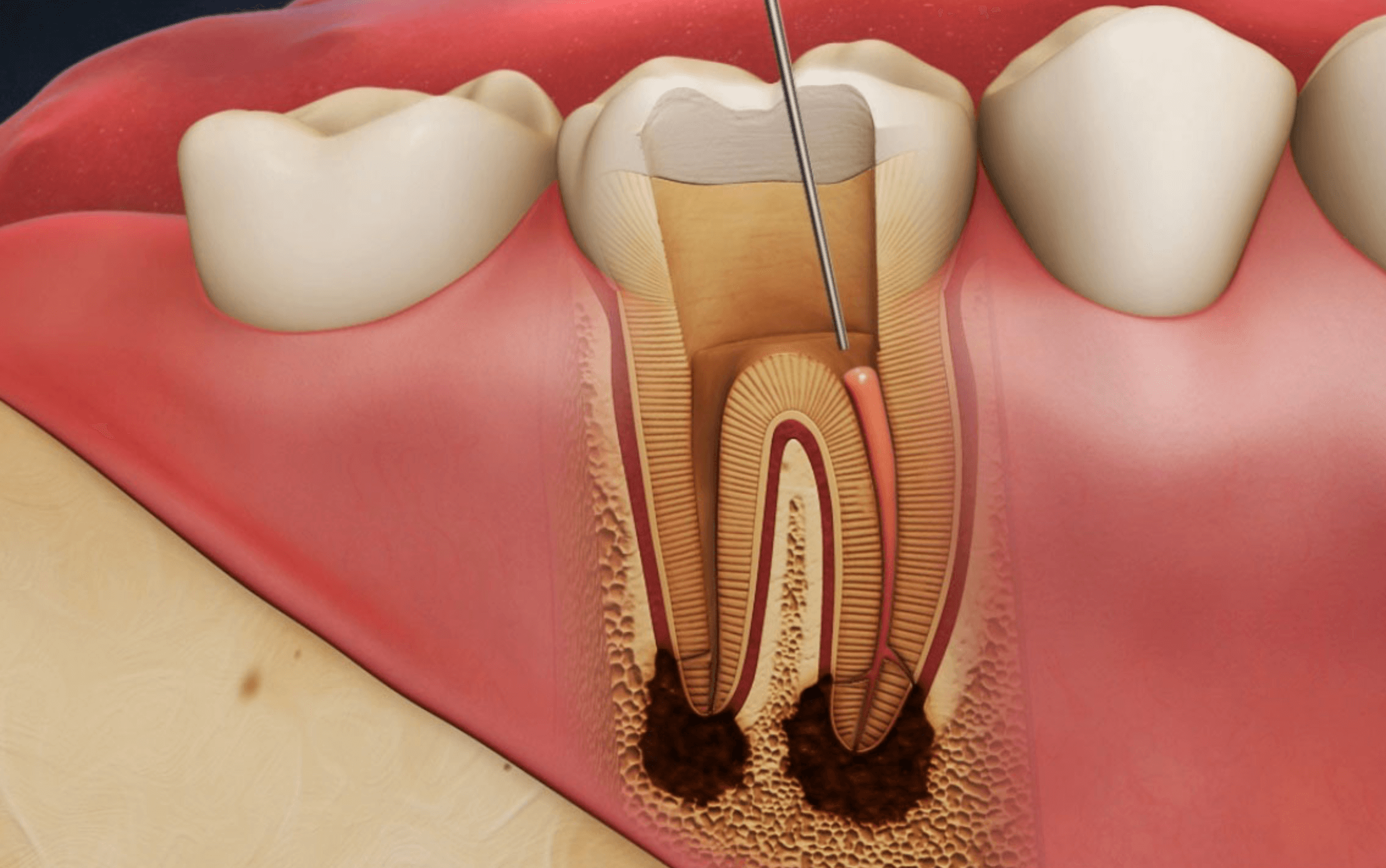치아뿌리 신경치료