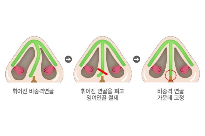 비중격 만곡증 증상