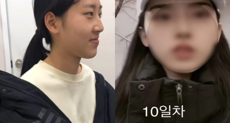  졸업하자마자 쌍수+코 수술 했던 여고생의 성형 브이로그