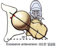 고관절을 이루는 각도가 너무 커서 제위치에 있지 않고 약간더 앞으로 나와 있는 그림