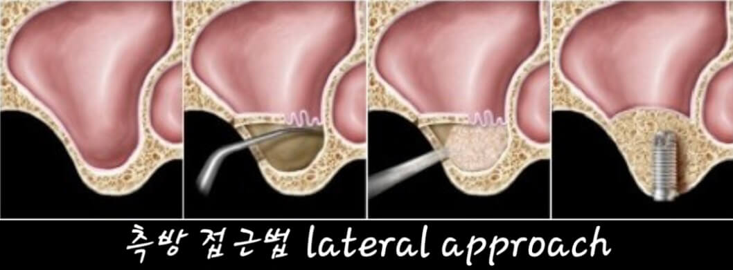 측방접근법