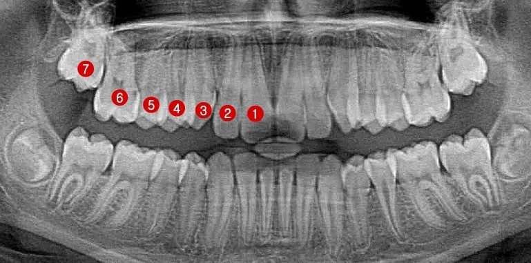 성인 치아 X-ray