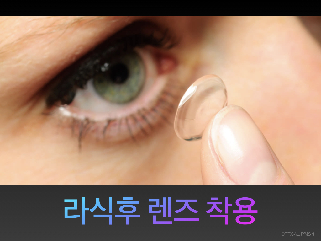  라식후 렌즈 착용 가능할까?
