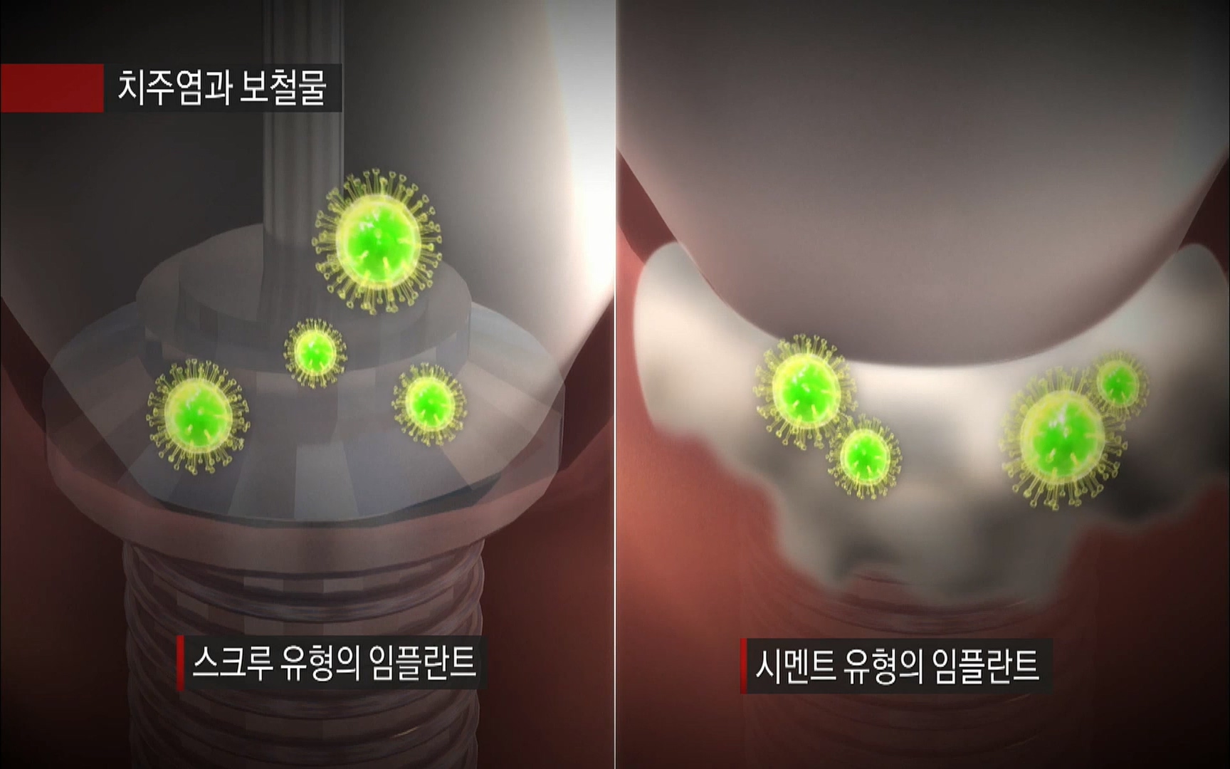 EBS 명의 헬스케어 - TV - 교육의 중심 EBS2015년 1월 16일 (금) 밤 9시 50분, EBS1.mp4_20220505_150405.210.jpg